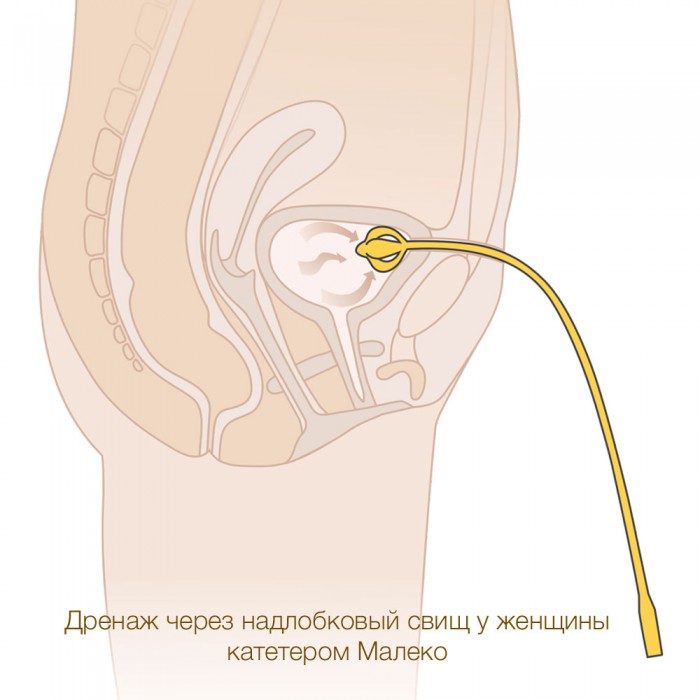 Дренаж через надлобковый свищ у женщины
катетером Малеко MEDEREN