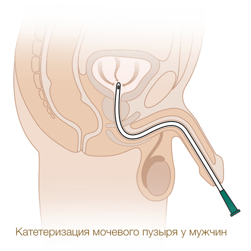 Катетеризация мочевого пузыря мужчины катетером Нелатона MEDEREN