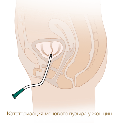 Катетеризация мочевого пузыря женщины катетером Нелатона MEDEREN