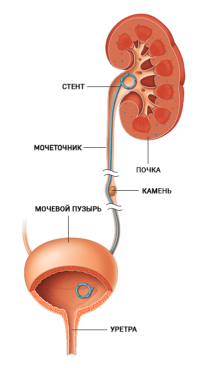 Схема использования мочеточникового стента