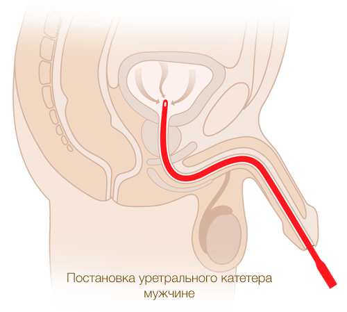 Установка уретрального катетера мужчине производства MEDEREN