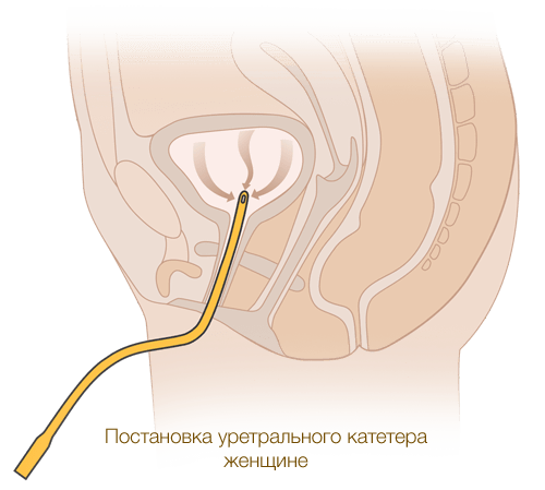 Установка уретрального катетера женщине производства MEDEREN