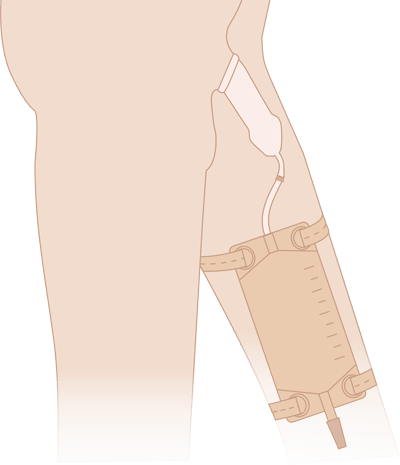 Схема использования носимого мочеприемника с уропрезервативом  MEDEREN