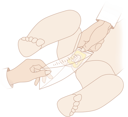Схема использования носимого мочеприемника MEDEREN