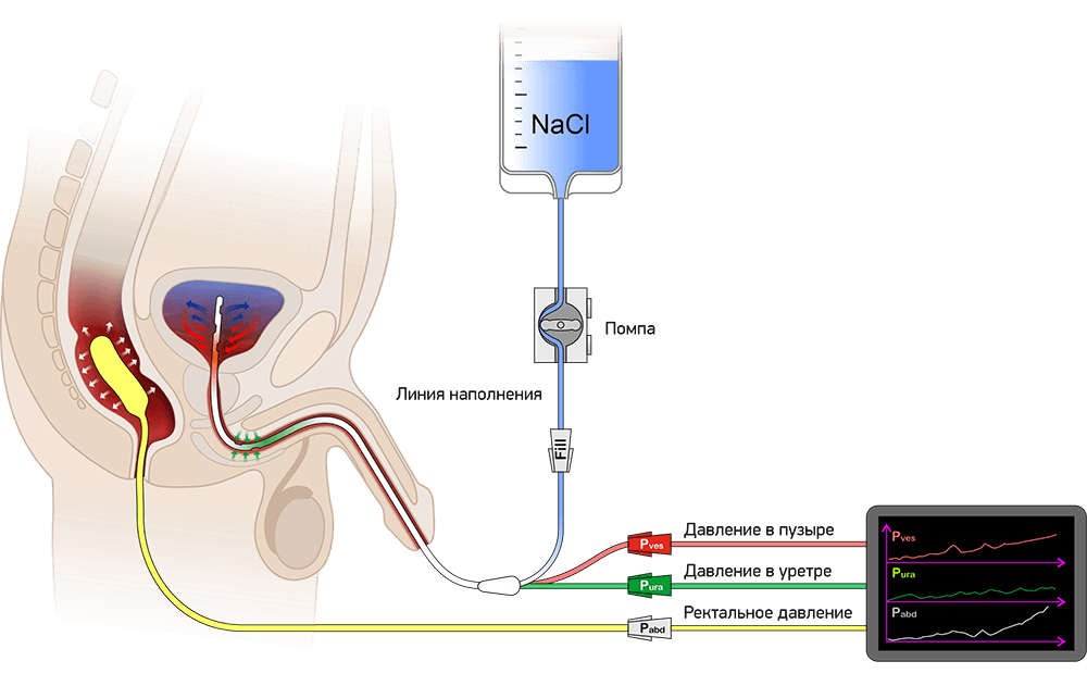 Схема использоваия катетеров для цистометрии