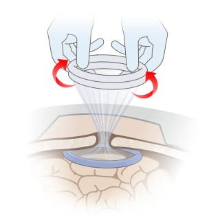 Выворачивая белое кольцо «внутрь», создайте операционное поле