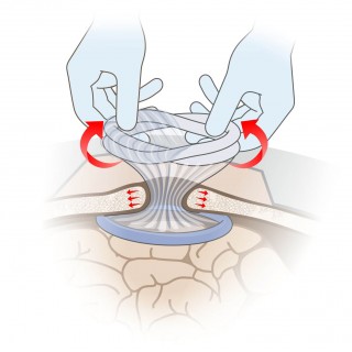 Убедитесь в правильной постановке  устройства в ране