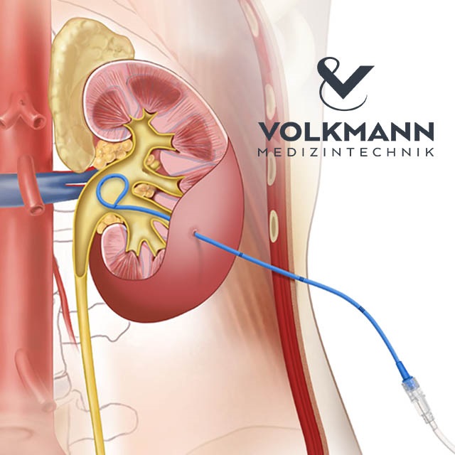 Дренирование верхних мочевых путей методом чрескожной пункционной нефростомии