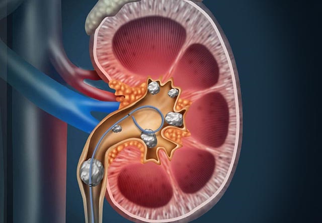 Стентирование мочеточника как эффективное решение восстановления верхних мочевыводящих путей