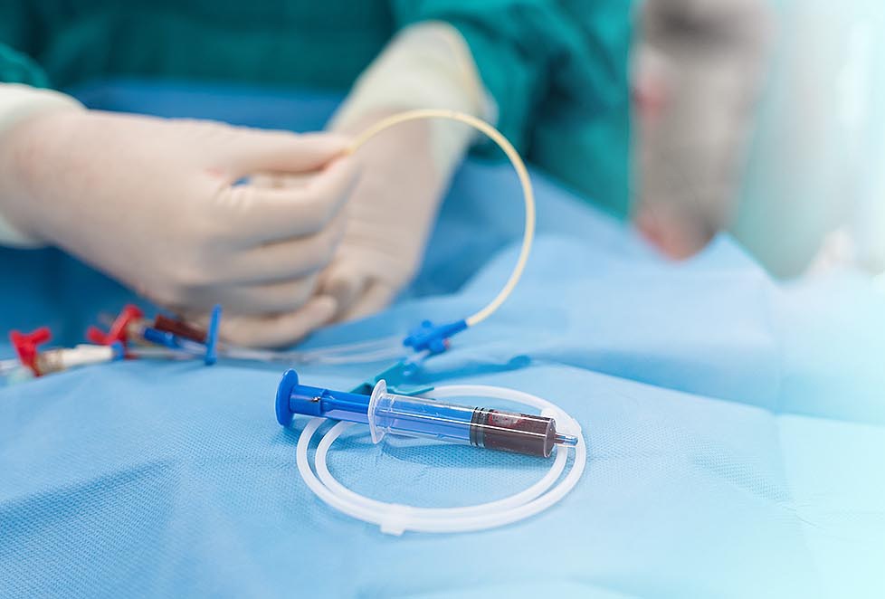 Применение ЦВК второго поколения в профилактике катетер-ассоциированной инфекции кровотока