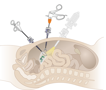 Эффективность применения мешков для эвакуации биологического материала в лапароскопии