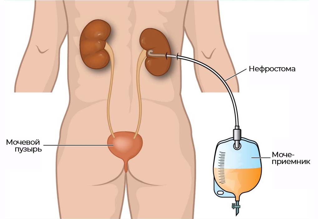 Уход за нефростомой